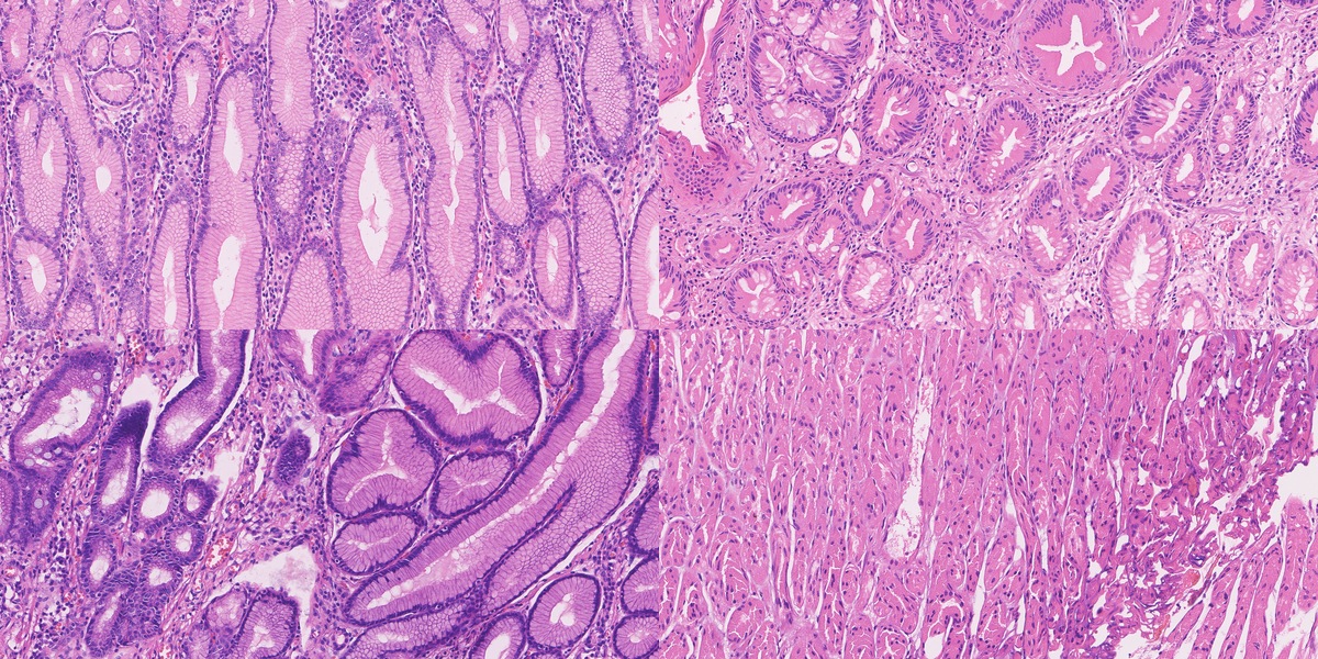 Real HiESD fields representing chronic gastritis, intestinal metaplasia, mixed regions and normal glands