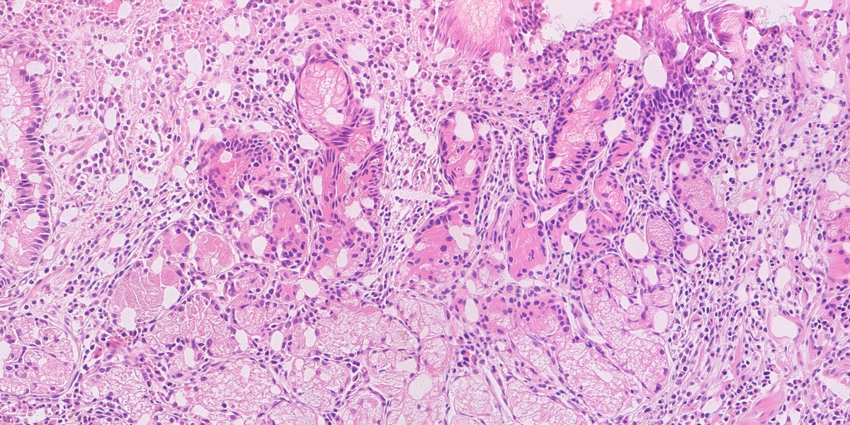 Synthetic gastric H&E image 01: HP with gastritis