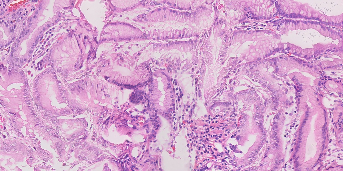 Synthetic gastric H&E image 02: HP with gastritis