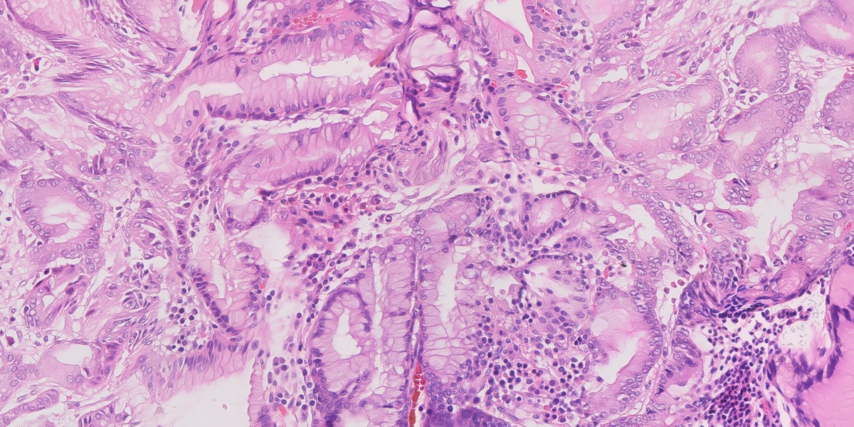 Synthetic gastric H&E image 03: HP with gastritis
