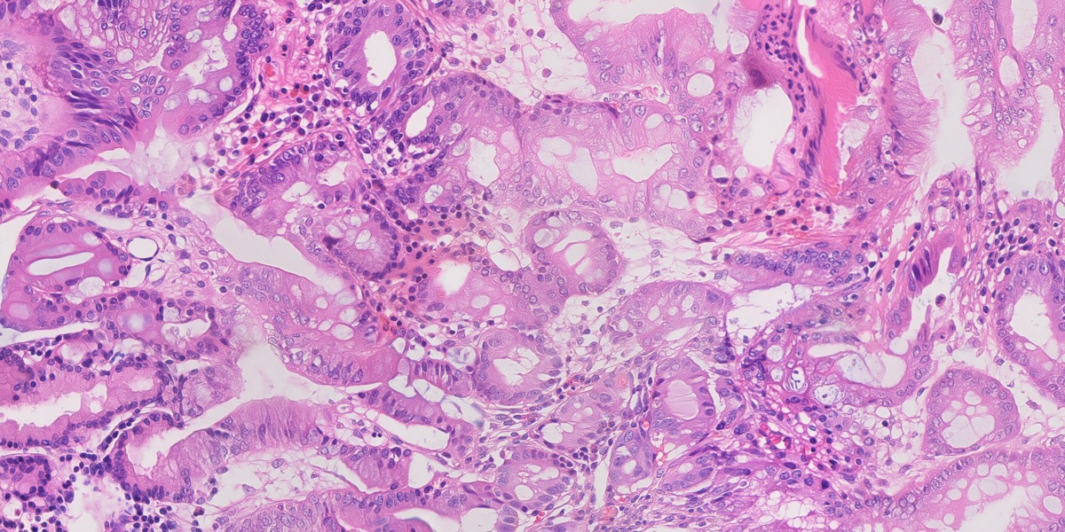 Synthetic gastric H&E image 04: Intestinal metaplasia