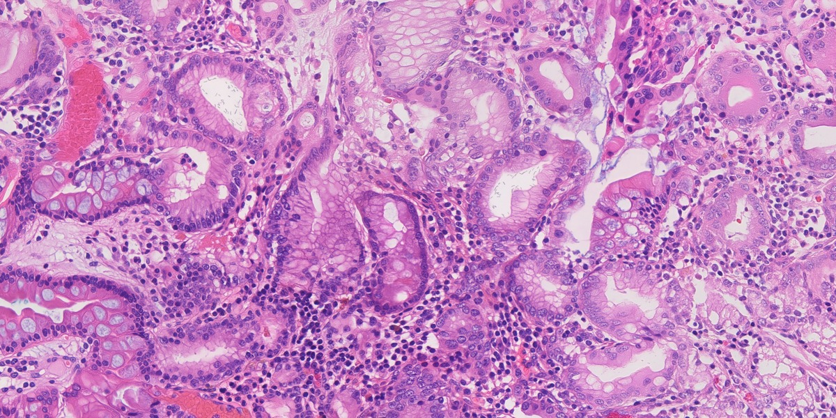 Synthetic gastric H&E image 06: HP, gastritis and IM