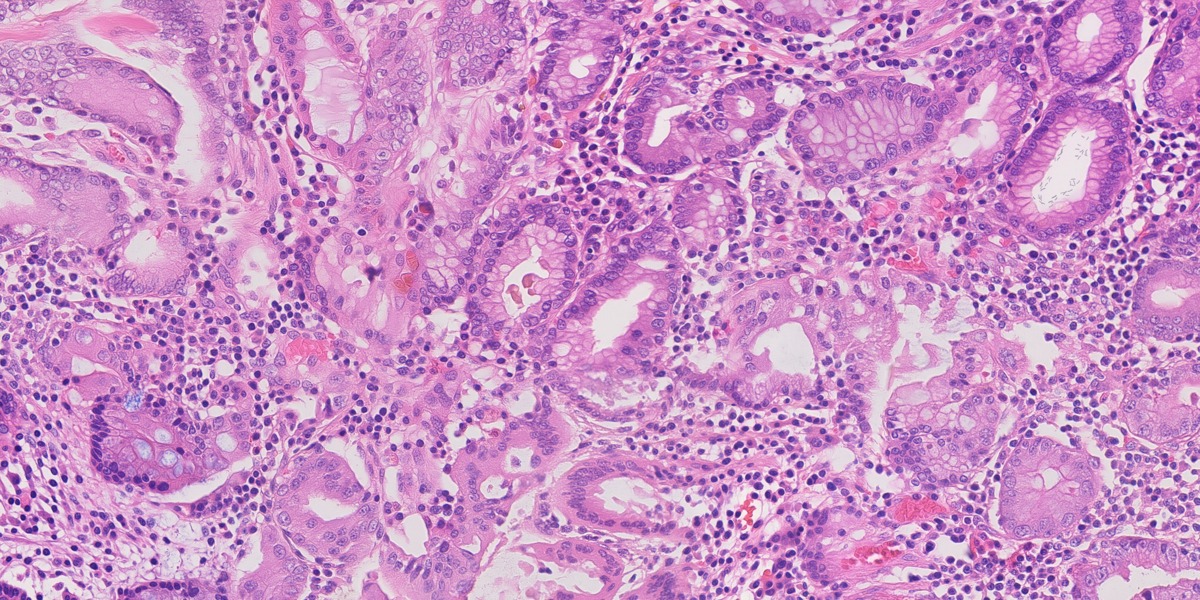 Synthetic gastric H&E image 07: HP, gastritis and IM
